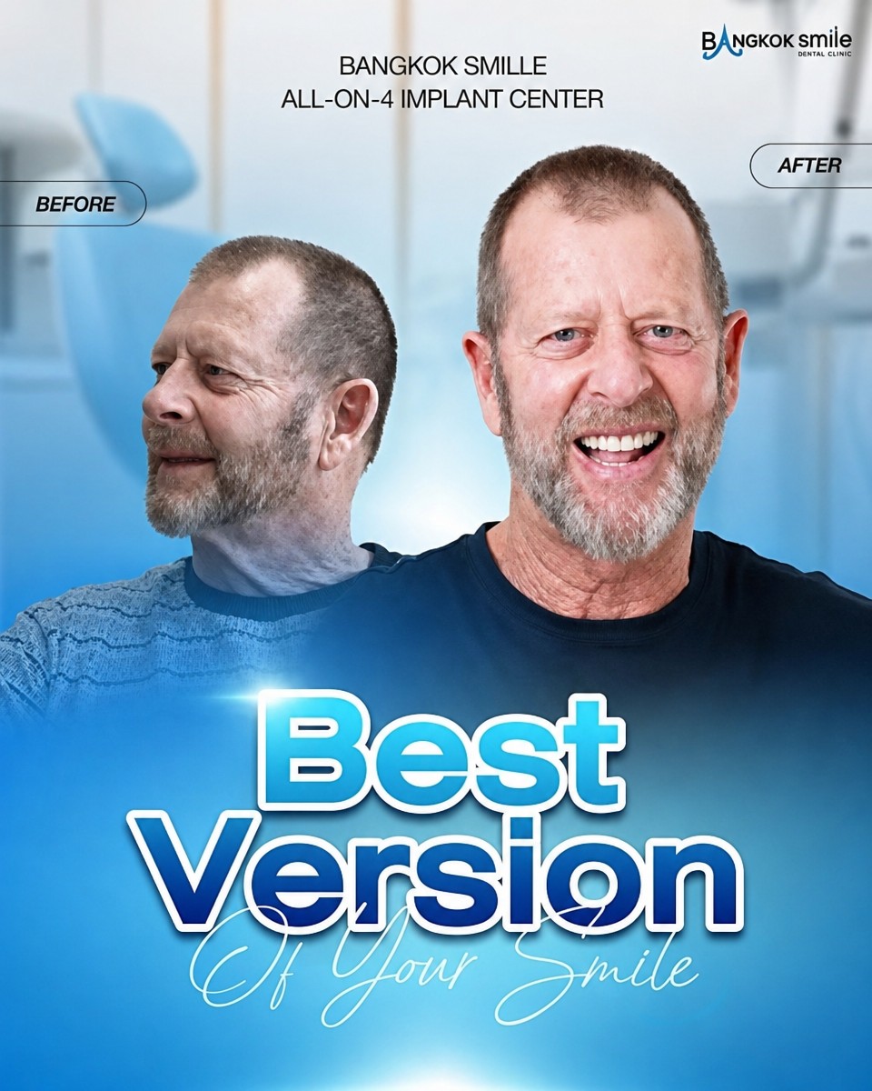 Результат до и после имплантации All-on-4 в Bangkok Smile Dental Group, улучшенная улыбка