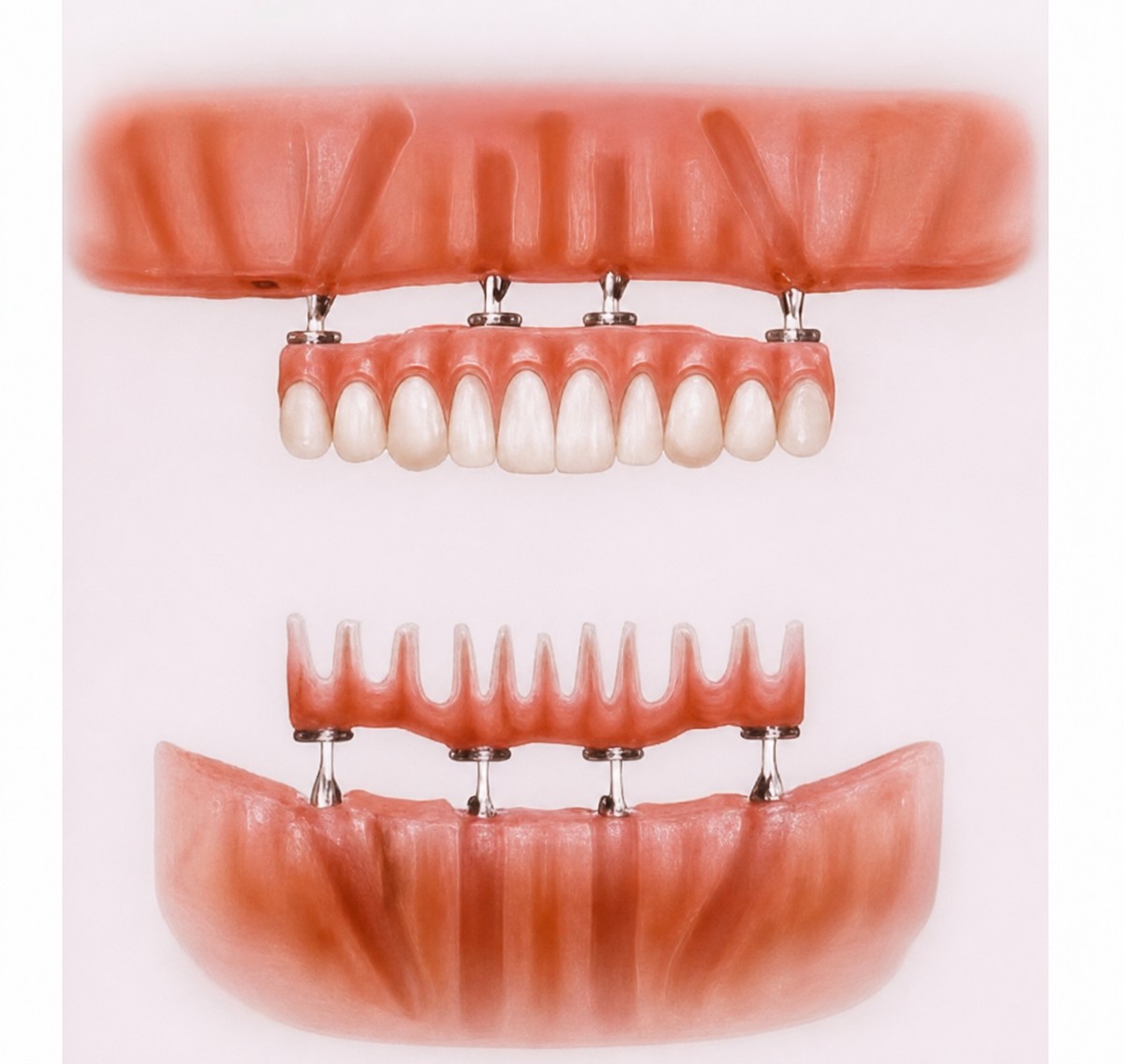 Resultado de implantes dentales All-on-4 en Bangkok Smile Dental Group, restauración total visible