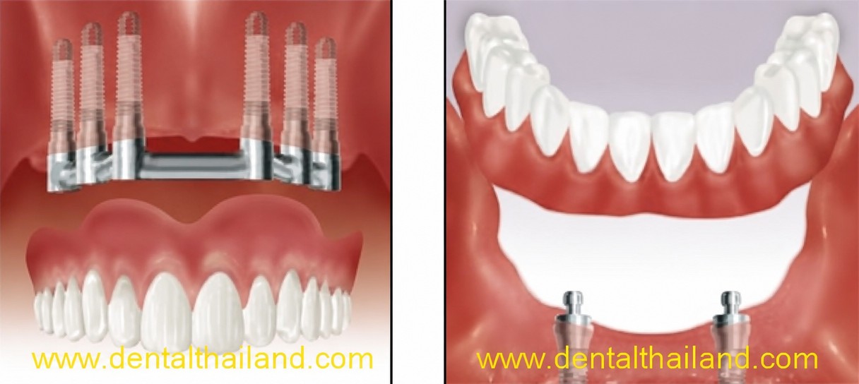 Результаты до и после All-on-4 имплантации в Bangkok Smile Dental Group, восстановление зубного ряда