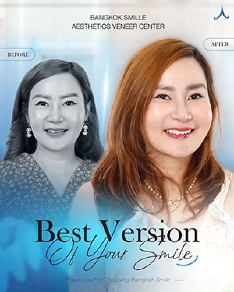 Результат до и после установки виниров Emax в Bangkok Smile Dental Group, преображение улыбки