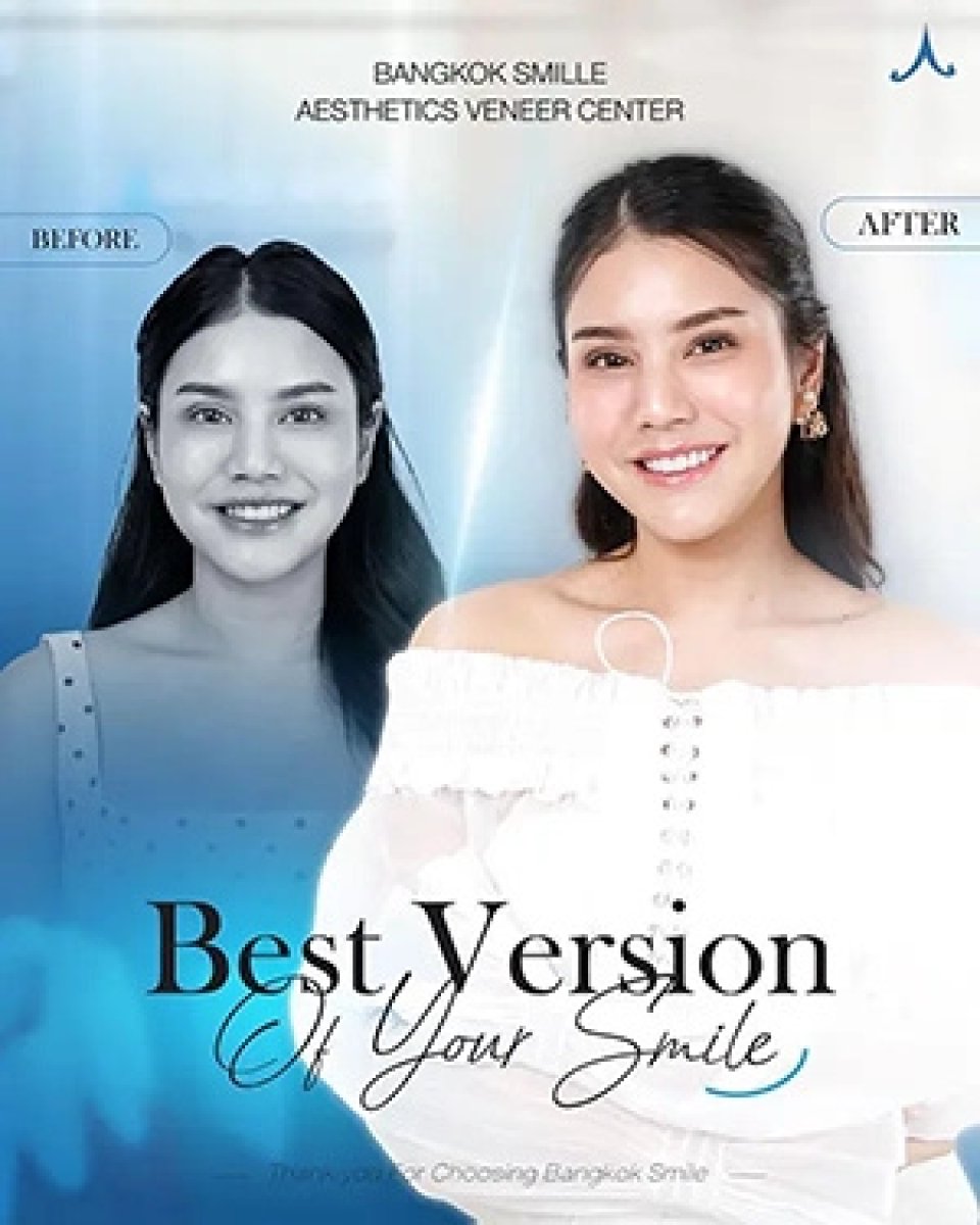 Результат до и после установки виниров Emax в Bangkok Smile Dental Group, преображение улыбки