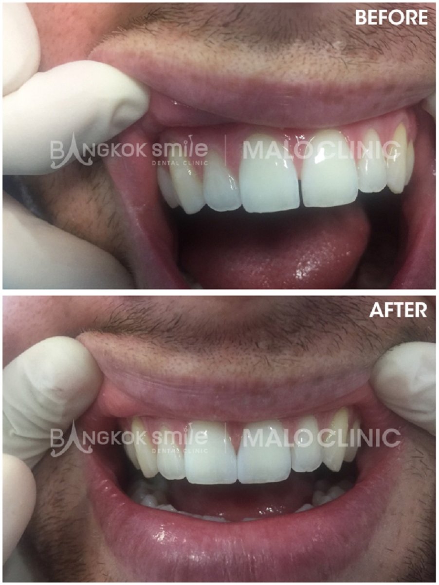 Résultats avant/après facettes en porcelaine chez Bangkok Smile Dental Group, sourire amélioré