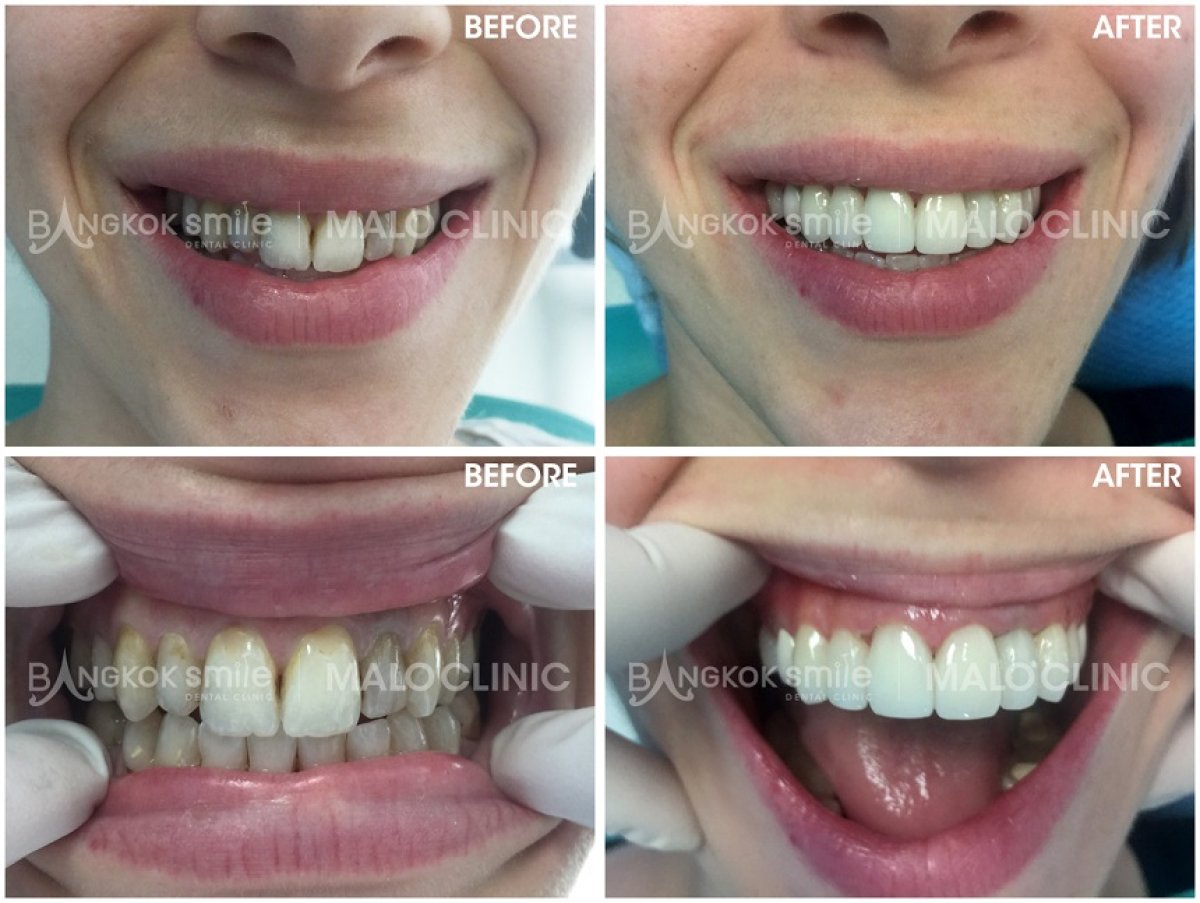 Résultats avant et après facettes en porcelaine chez Bangkok Smile Dental Group, sourire transformé