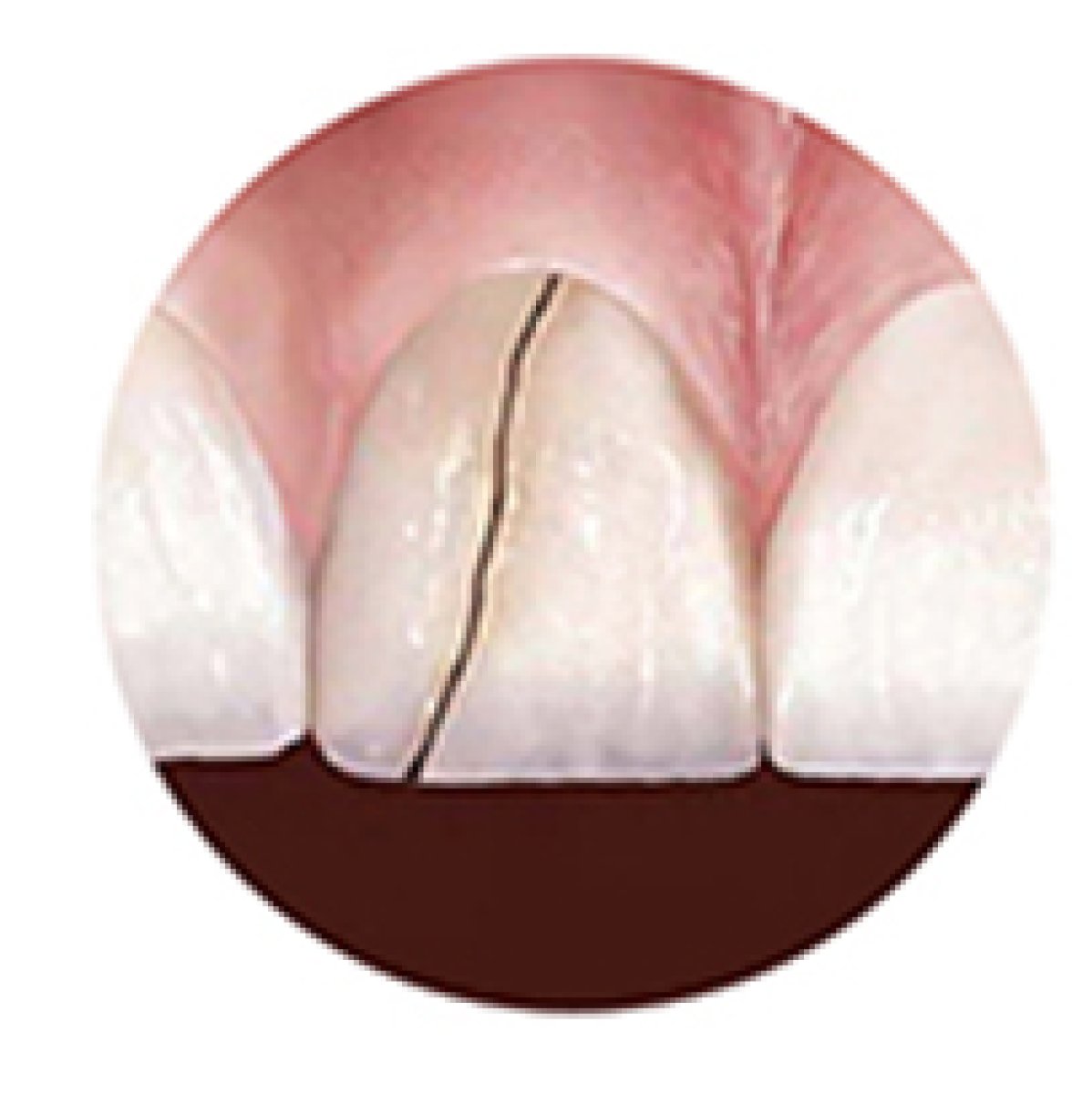سن أمامي متشقق قبل علاج القشرة الخزفية في Bangkok Smile Dental Group