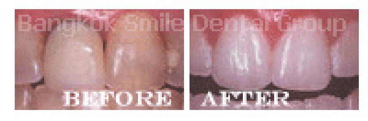 نتائج قبل وبعد عدسات الأسنان الخزفية في Bangkok Smile Dental Group، أسنان أكثر بياضًا