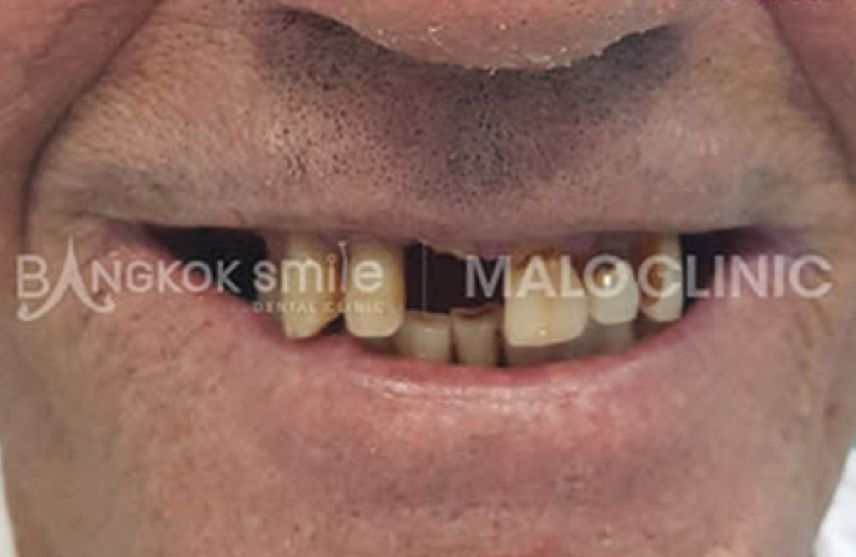 Avant traitement par dentier chez Bangkok Smile Dental Group, dents manquantes et abîmées visibles