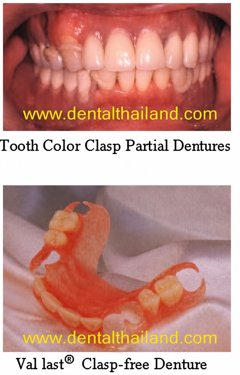 Результаты частичных протезов в Bangkok Smile Dental Group – с кламмерами и без них