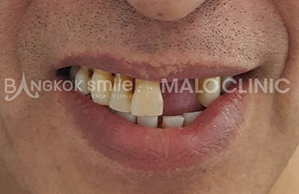 До процедуры протезирования в Bangkok Smile Dental Group, видны отсутствующие и поврежденные зубы