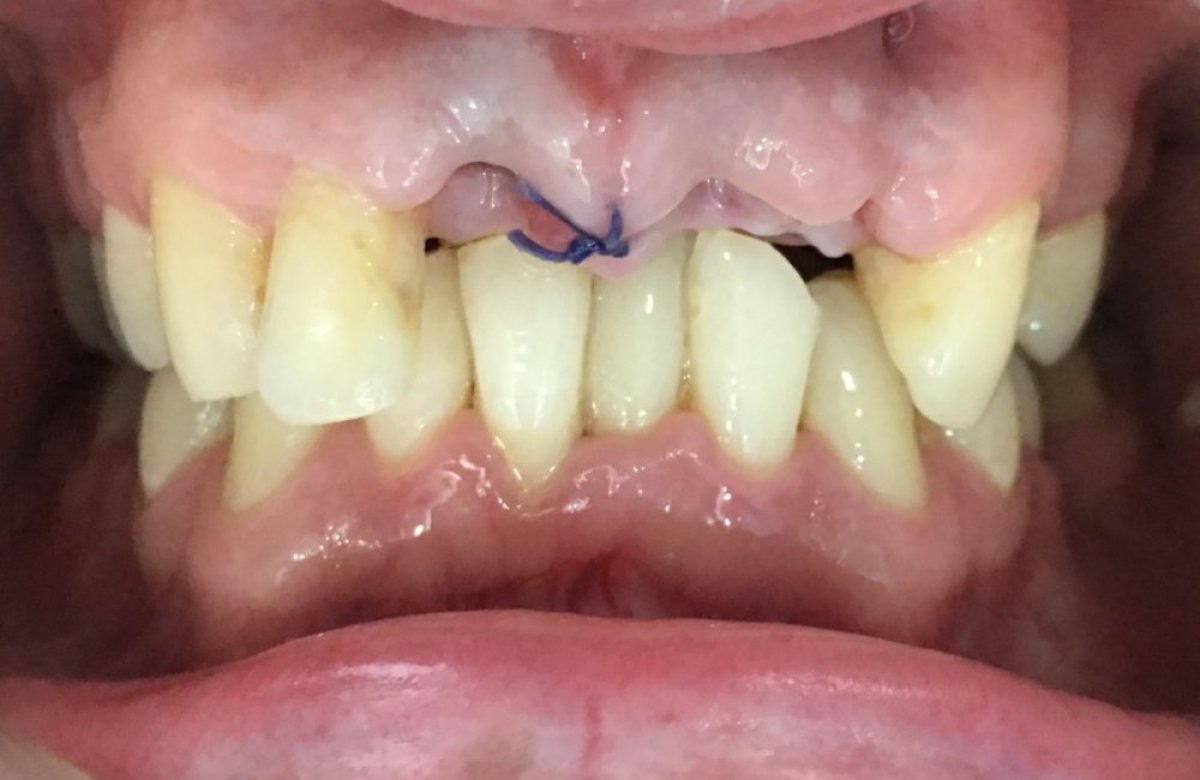 نتيجة جراحة اللثة في Bangkok Smile Dental Group، تظهر الغرز ومنطقة اللثة المتعافية