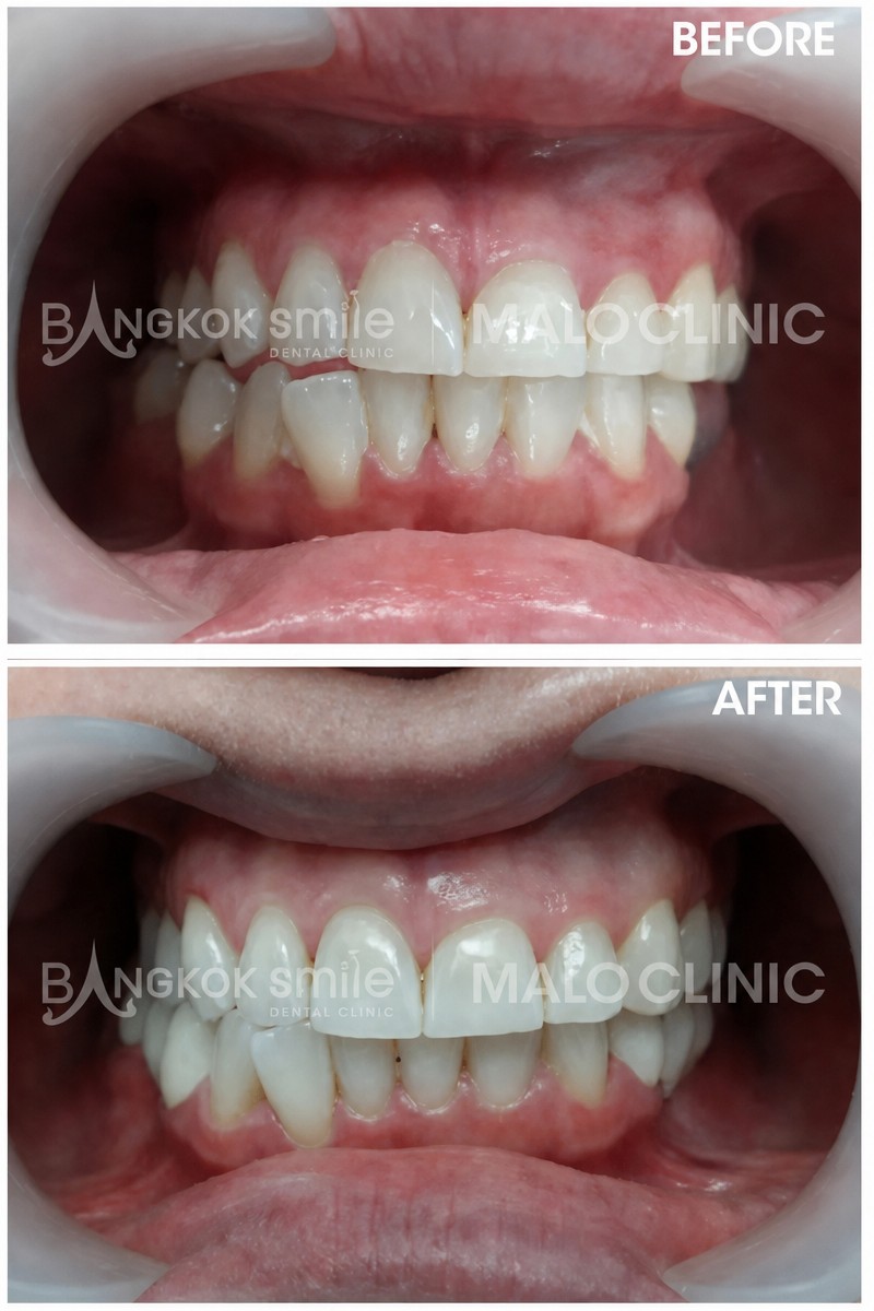 Результаты до и после брекетов в Bangkok Smile Dental Group, выравнивание зубов
