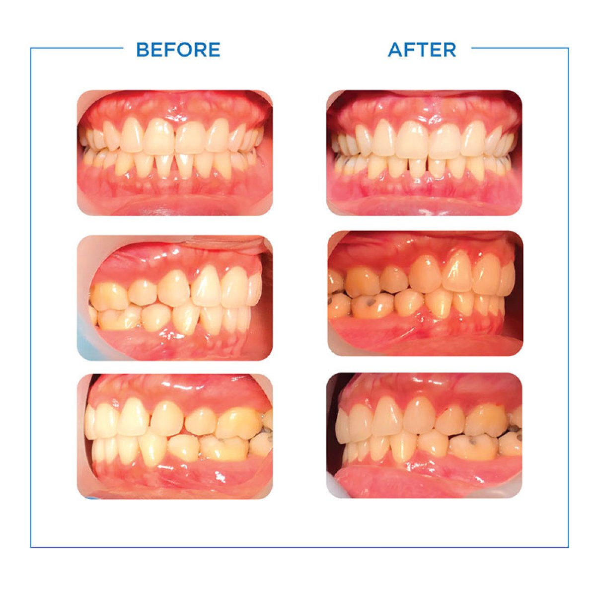 Resultados de ortodoncia antes y después en Bangkok Smile Dental Group, alineación dental mejorada