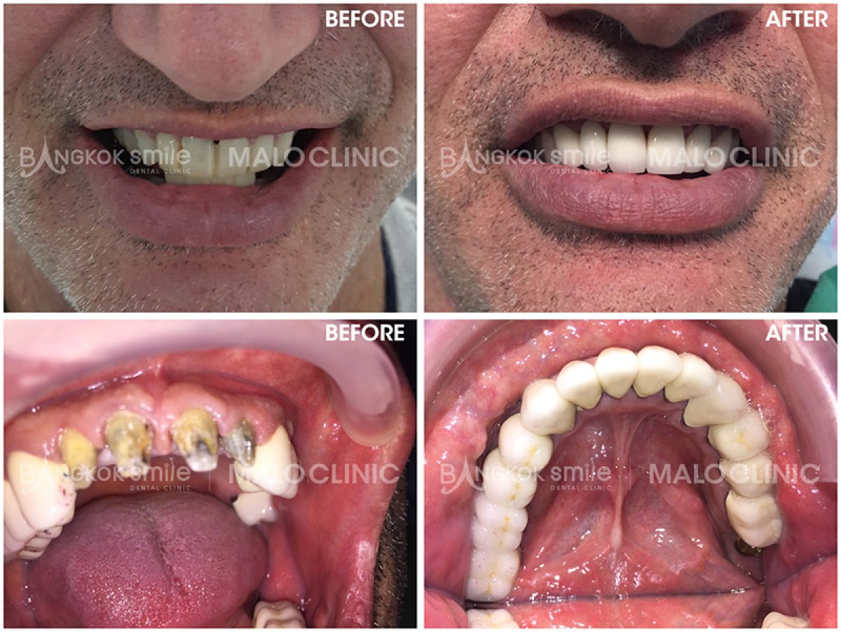 Результат до и после имплантации All-on-6 в Bangkok Smile Dental Group, полное восстановление улыбки