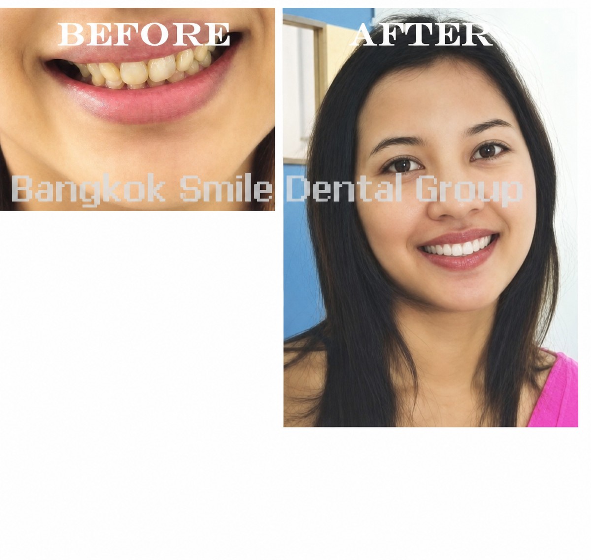 Результаты до и после отбеливания зубов в Bangkok Smile Dental Group, сияющая улыбка