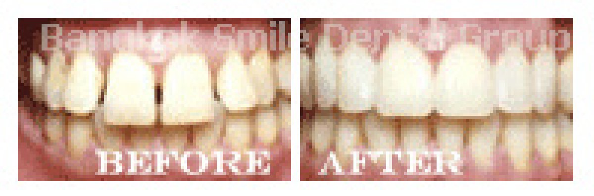 نتائج تبييض الأسنان قبل وبعد في Bangkok Smile Dental Group، أسنان أكثر بياضًا بوضوح