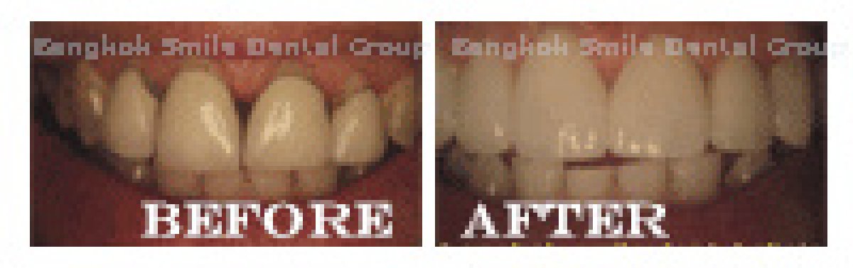 نتائج تبييض الأسنان قبل وبعد في Bangkok Smile Dental Group، ابتسامة أكثر إشراقًا