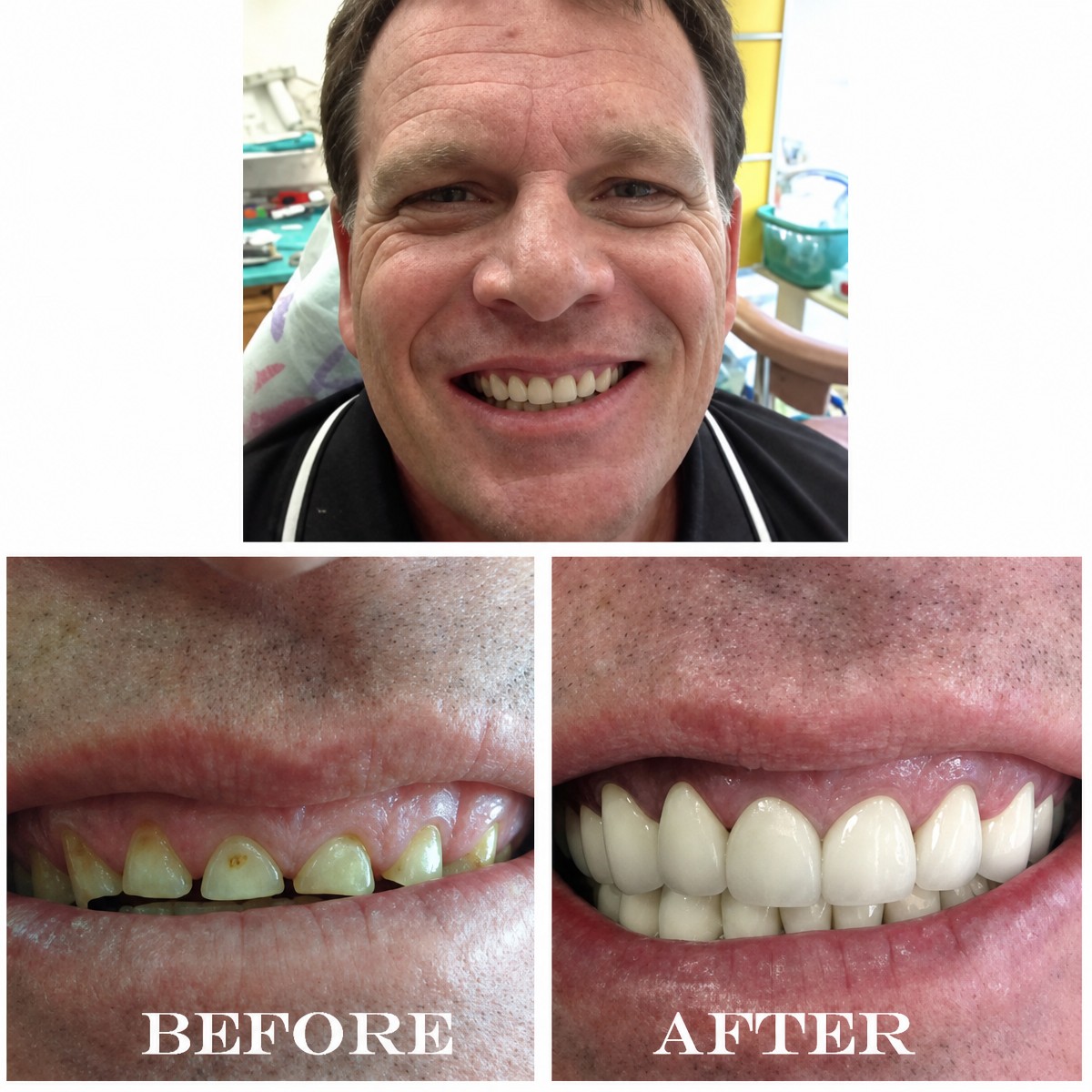 Результаты до и после отбеливания зубов в Bangkok Smile Dental Group, улыбка стала ярче