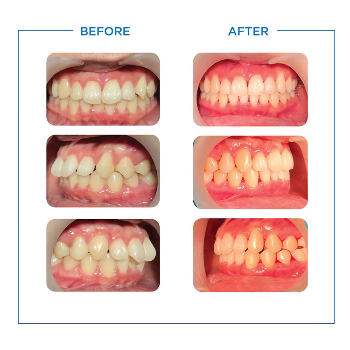 Before and after Invisalign results at Bangkok Smile Dental Group, teeth alignment improvement