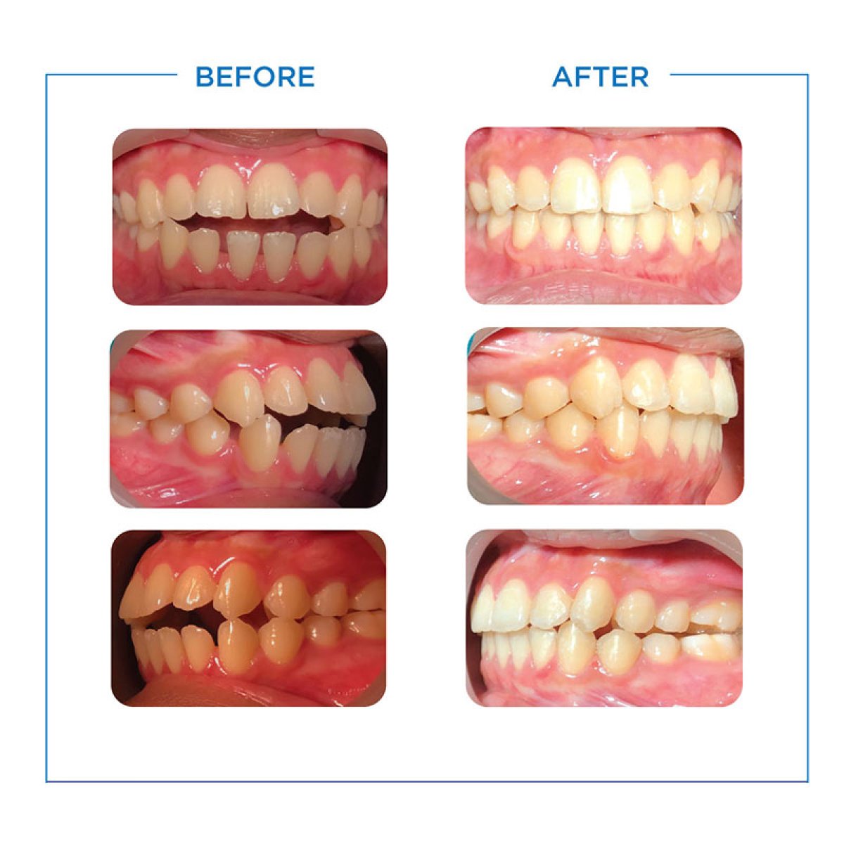 Before and after Invisalign results at Bangkok Smile Dental Group, teeth alignment improvement