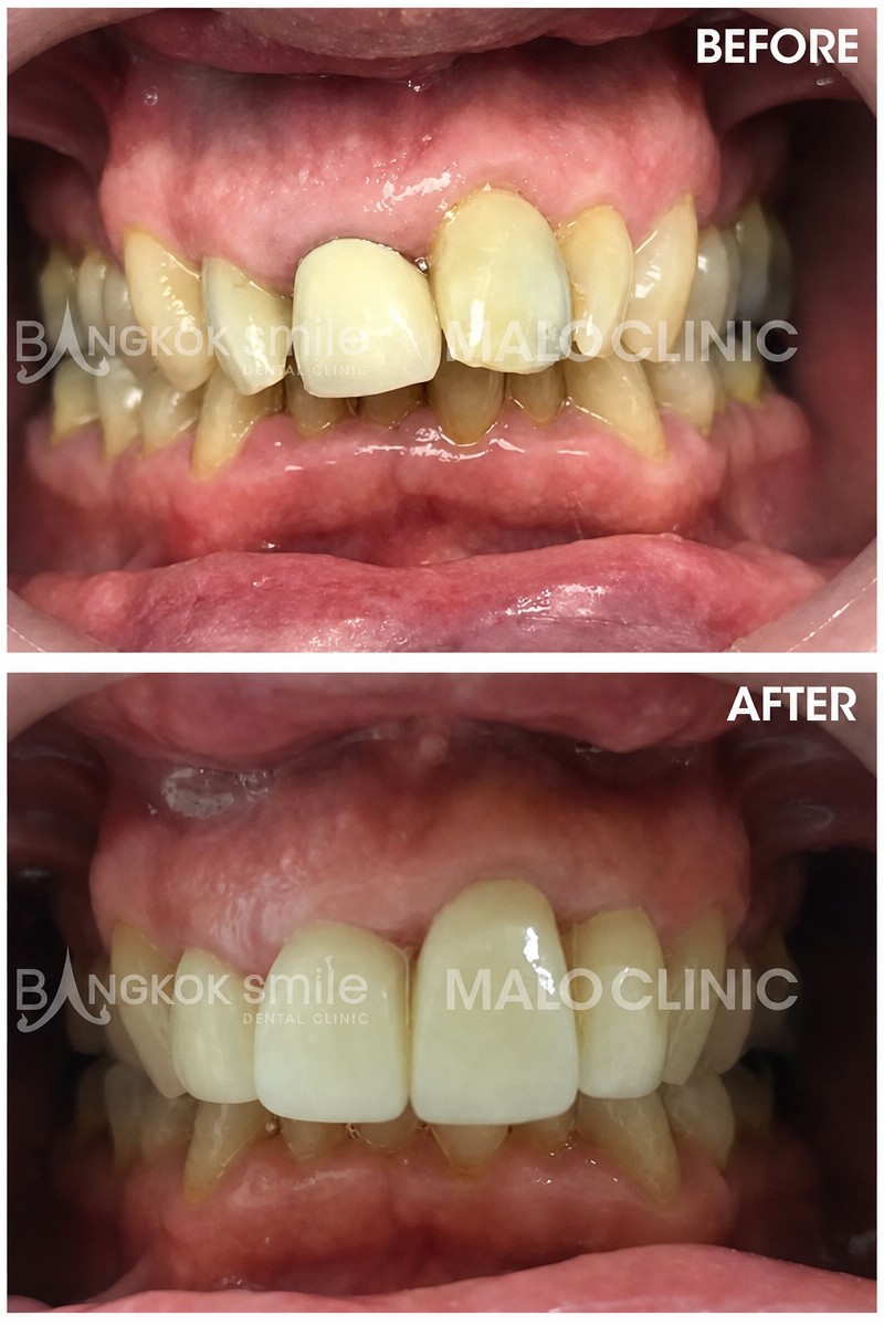 نتائج قبل وبعد فينير الأسنان في Bangkok Smile Dental Group وتحسن واضح في الابتسامة