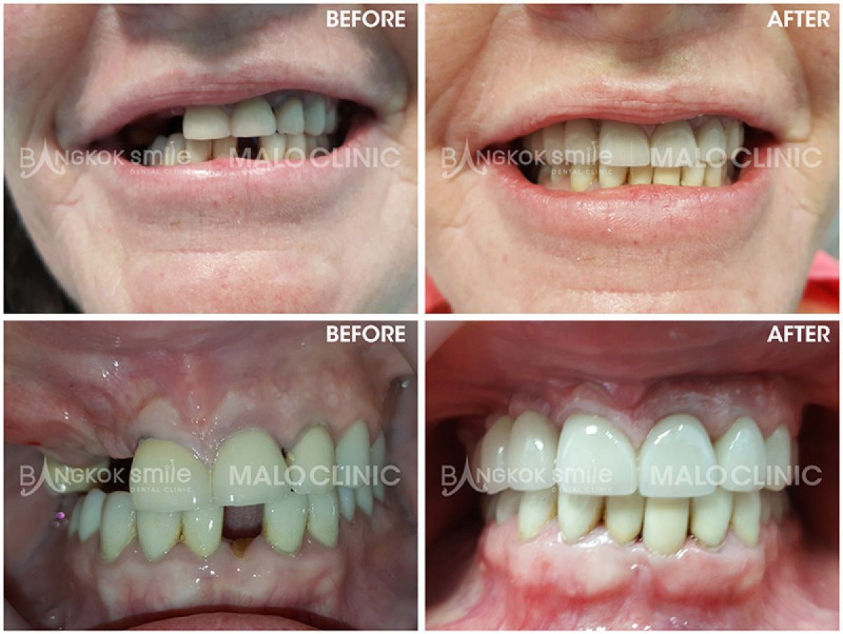 До и после установки виниров в Bangkok Smile Dental Group, улучшение улыбки и выравнивание зубов