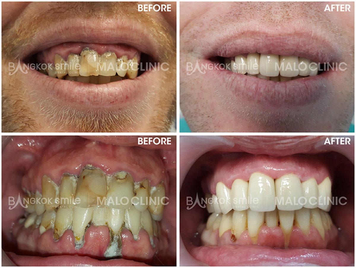 Résultats avant et après facettes dentaires chez Bangkok Smile Dental Group, sourire transformé