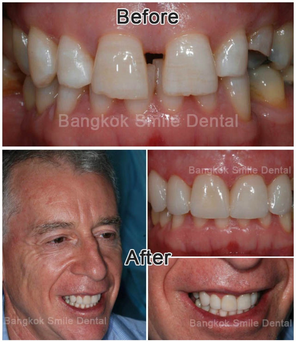 До та після встановлення вінірів у Bangkok Smile Dental Group – результат зміни усмішки