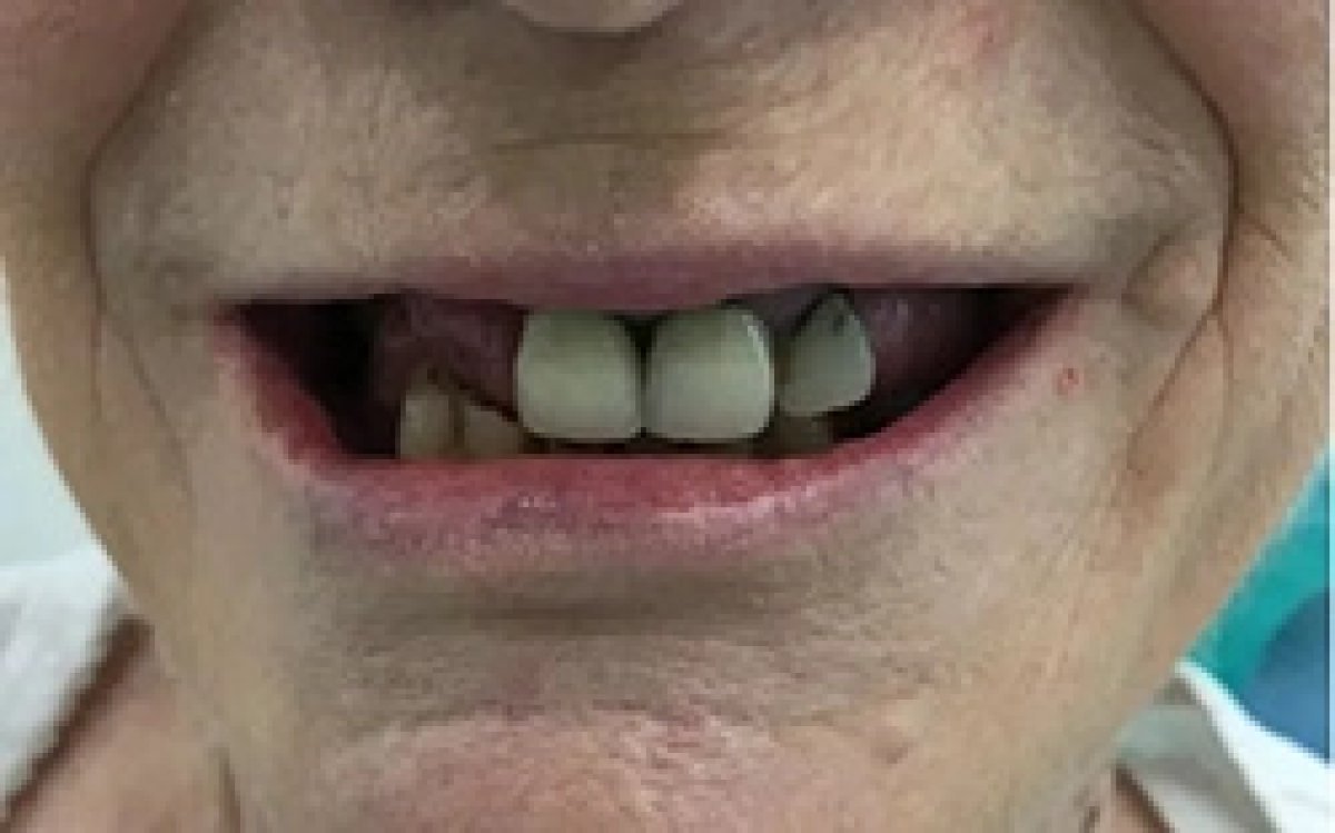 Before dental crown installation at Bangkok Smile Dental Group, visible missing and damaged teeth