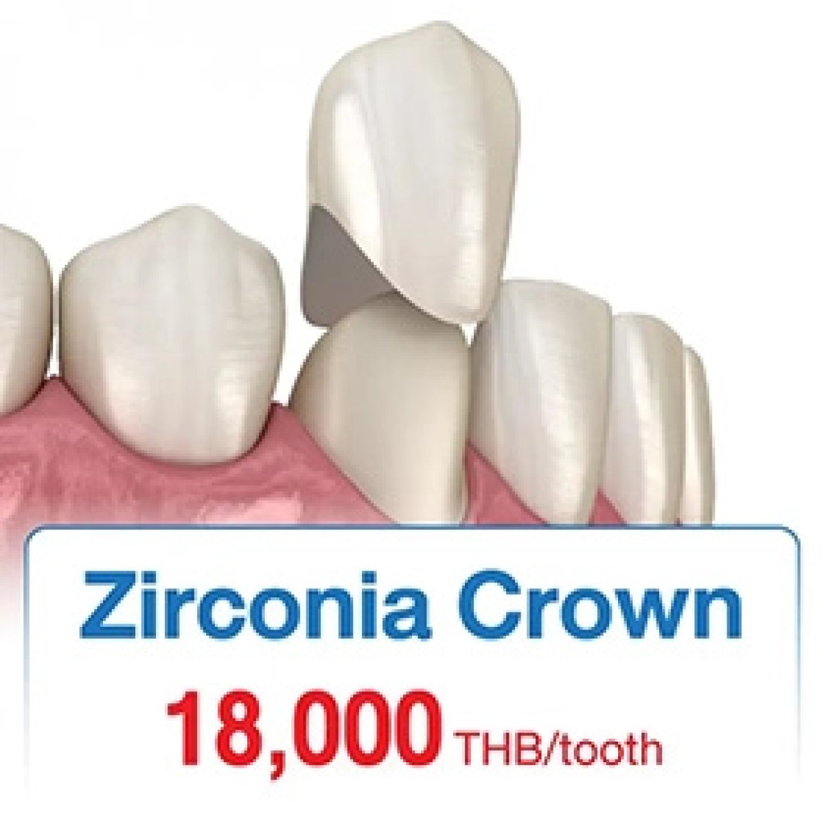 Zirconia dental crown installation result at Bangkok Smile Dental Group, natural tooth restoration