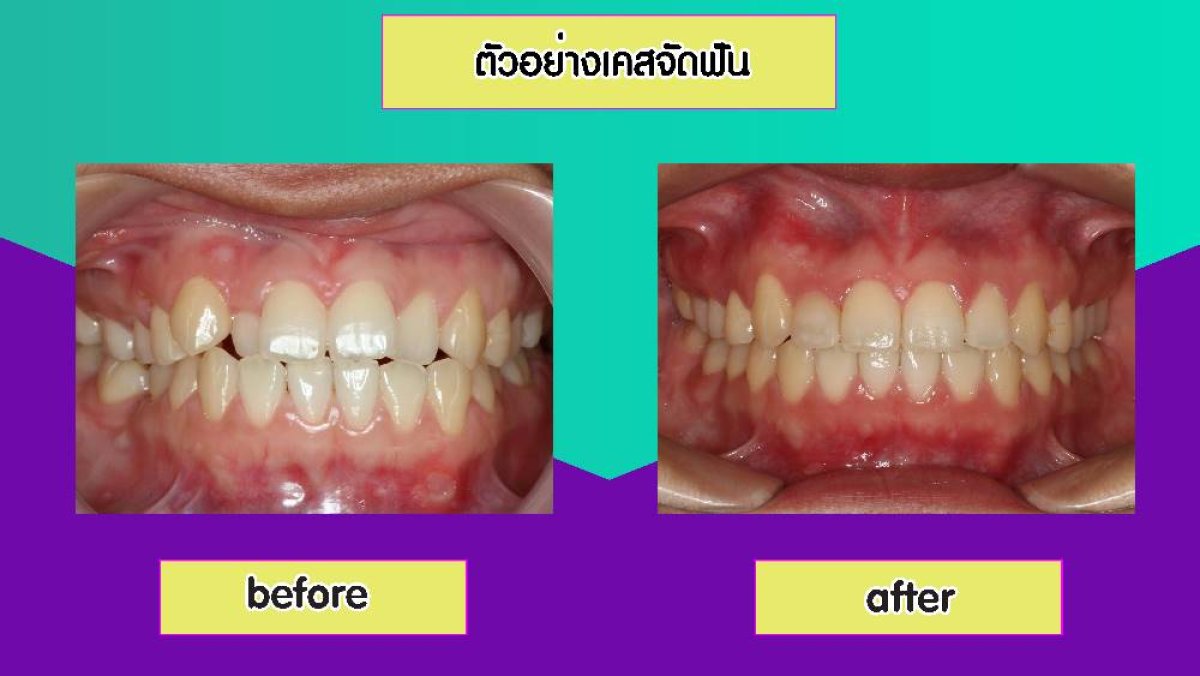 Resultados de alineación dental antes y después en Siam Station Dental Clinic, sonrisa mejorada