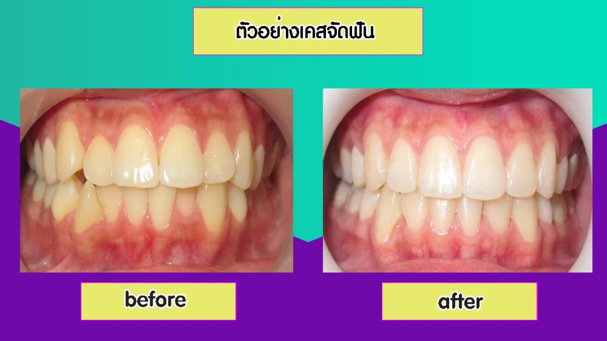 Результаты отбеливания зубов до и после в Siam Station Dental Clinic, заметно белее зубы