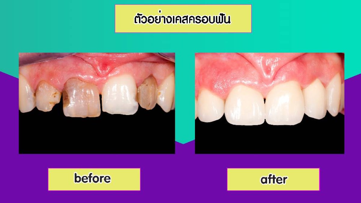 До и после установки зубных коронок в Siam Station Dental Clinic – улучшение цвета и формы