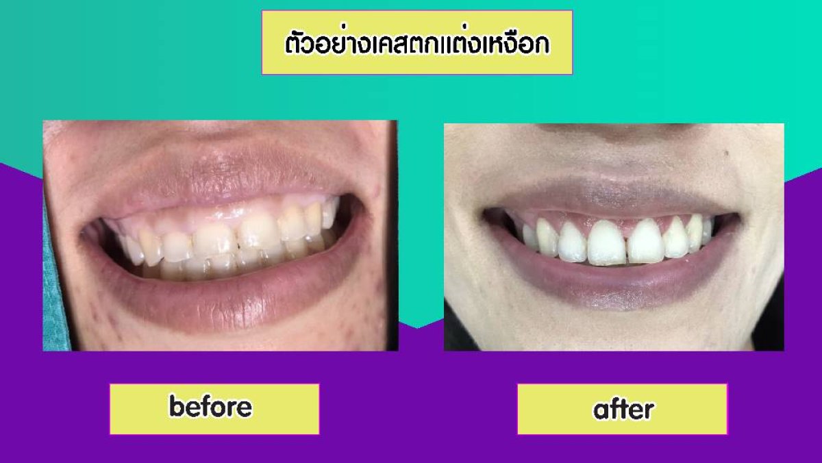 Resultados de blanqueamiento dental antes y después en Siam Station Dental Clinic, sonrisa más brillante