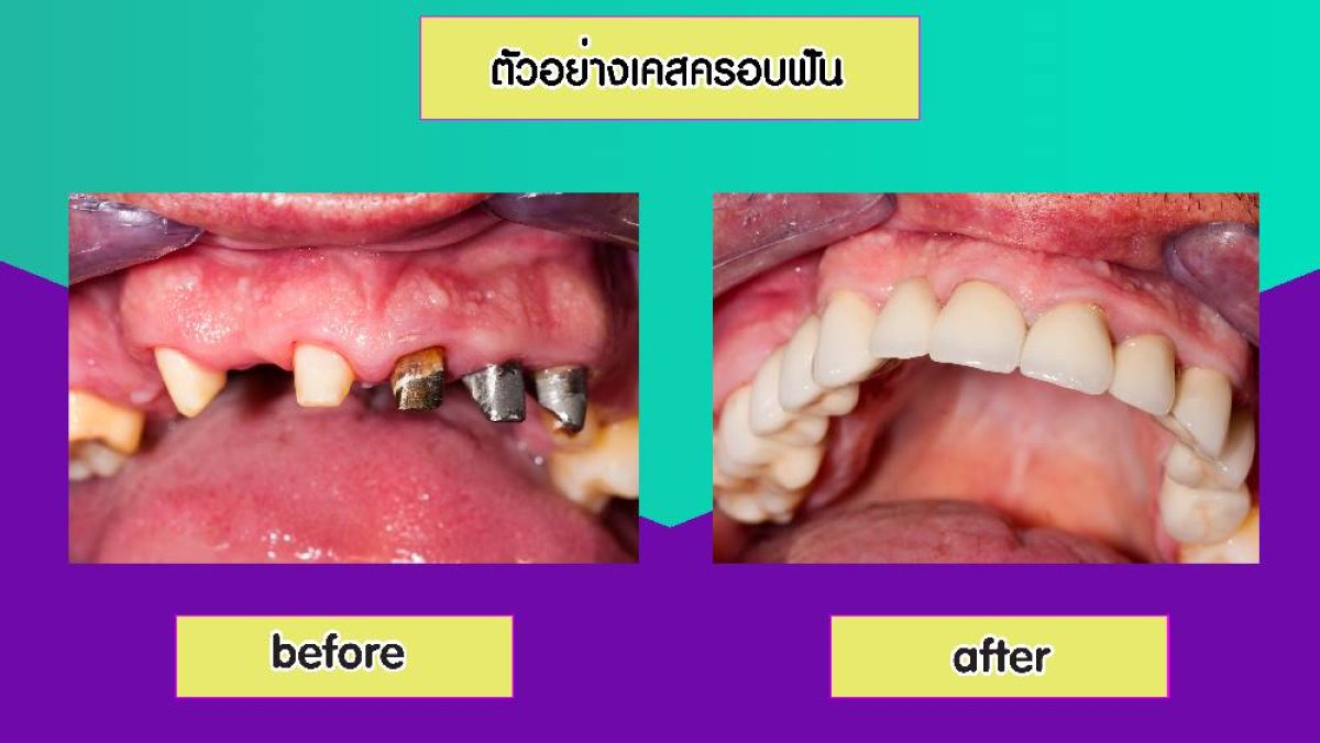 Vorher-nachher-Ergebnis Zahnkronen bei Siam Station Dental Clinic, verbesserte Zahnästhetik