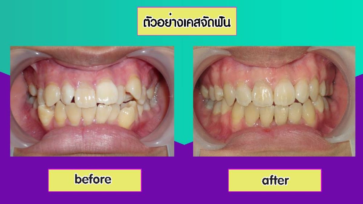 Before and after braces results at Siam Station Dental Clinic, improved teeth alignment
