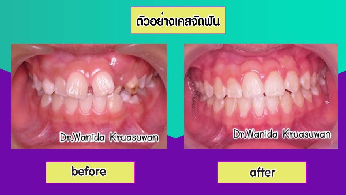 Before and after braces results at Siam Station Dental Clinic – improved teeth alignment