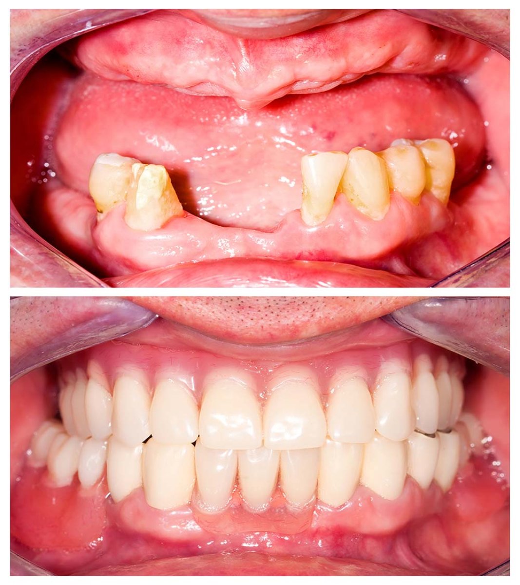 Результаты до и после имплантации зубов в Siam Station Dental Clinic, восстановление улыбки