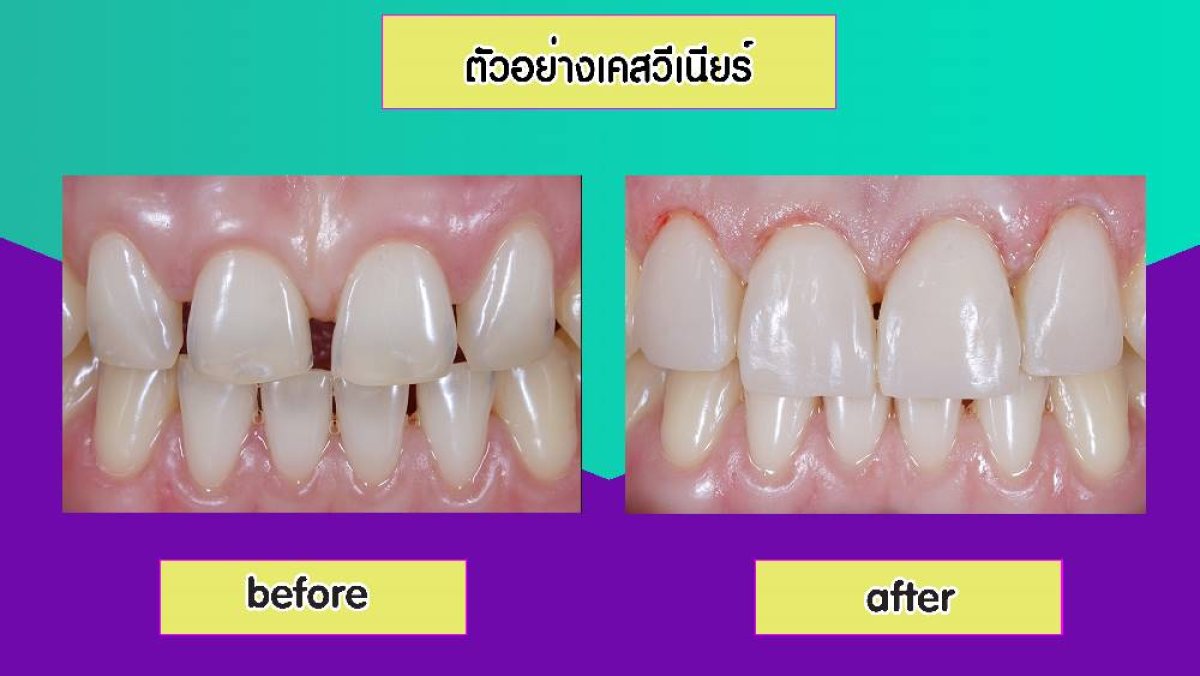 Результаты до и после установки фарфоровых виниров в Siam Station Dental Clinic, улучшение улыбки