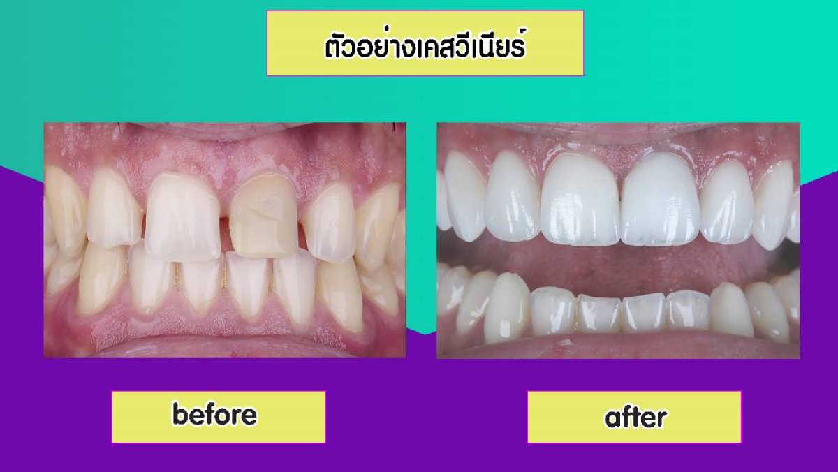 Результаты до и после установки фарфоровых виниров в Siam Station Dental Clinic, улыбка