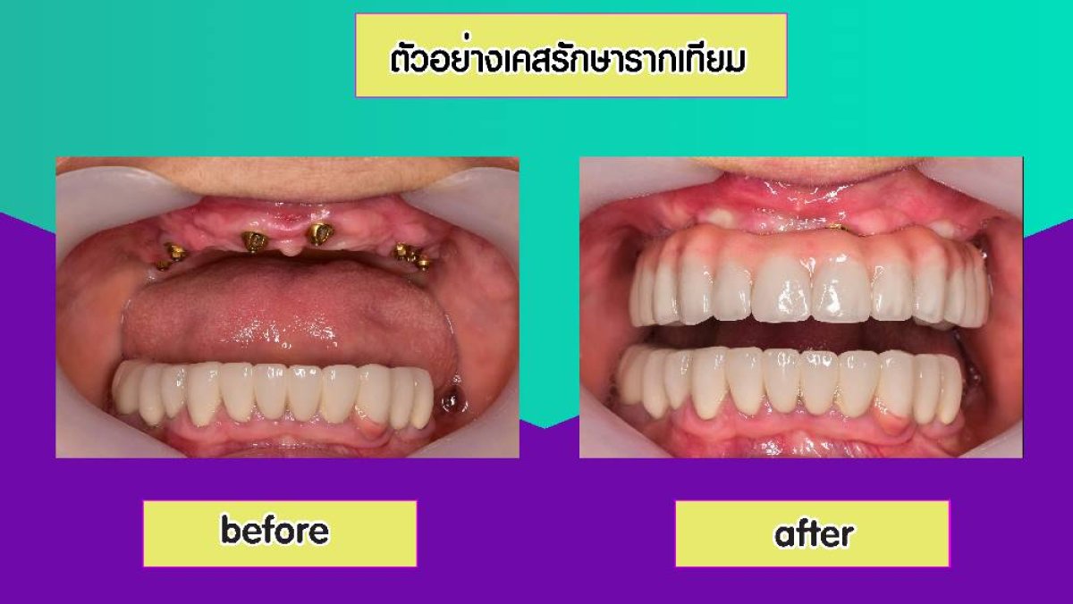 Before and after dental implant restoration results at Siam Station Dental Clinic, full arch