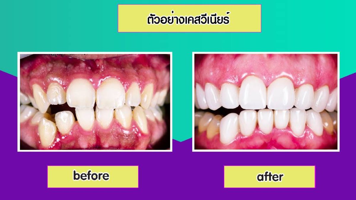Vorher-nachher Veneers bei Siam Station Dental Clinic, Ergebnis der Lächeln-Transformation