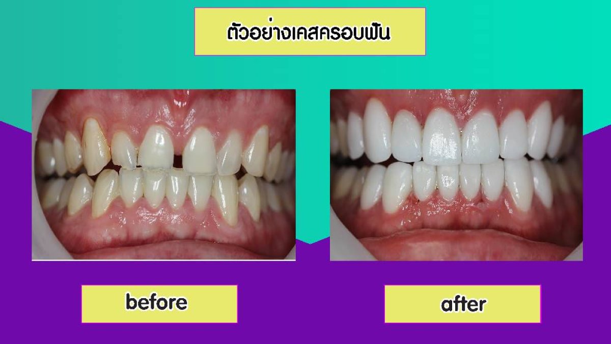 Before and after dental veneers at Siam Station Dental Clinic, smile makeover result