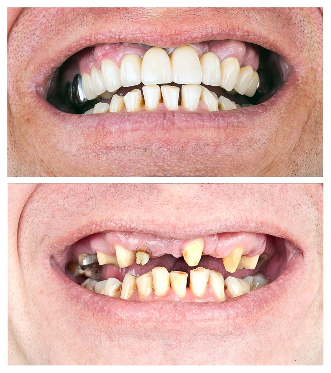 Before and after veneers at Siam Station Dental Clinic – smile restoration results