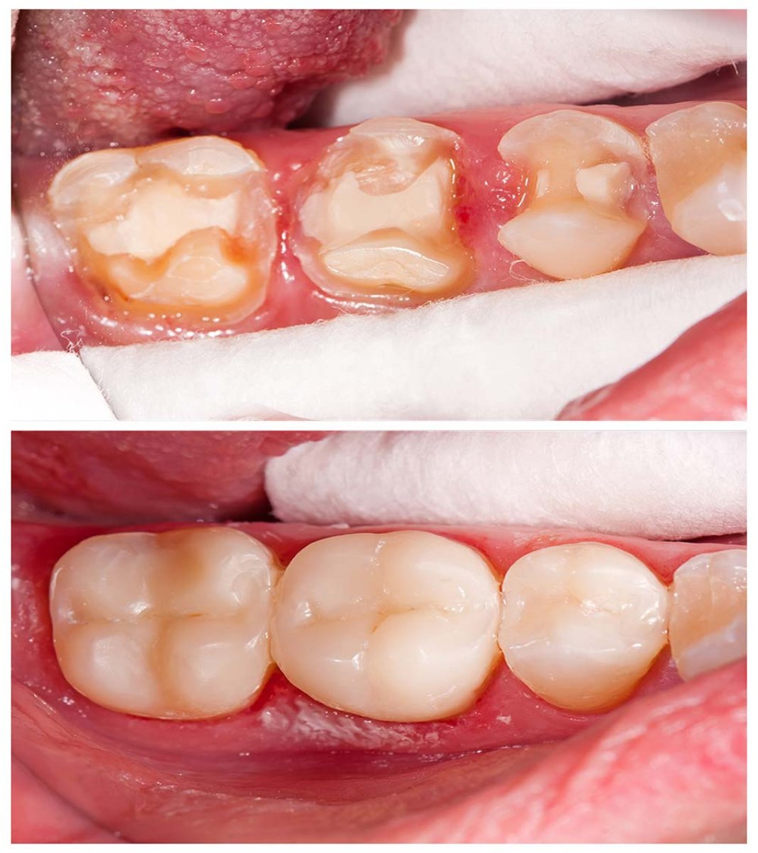 Результаты до и после композитной пломбы в Siam Station Dental Clinic, восстановленные моляры