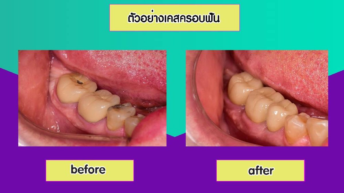 نتائج قبل وبعد تركيب تيجان الأسنان في Siam Station Dental Clinic، تحسين الأضراس