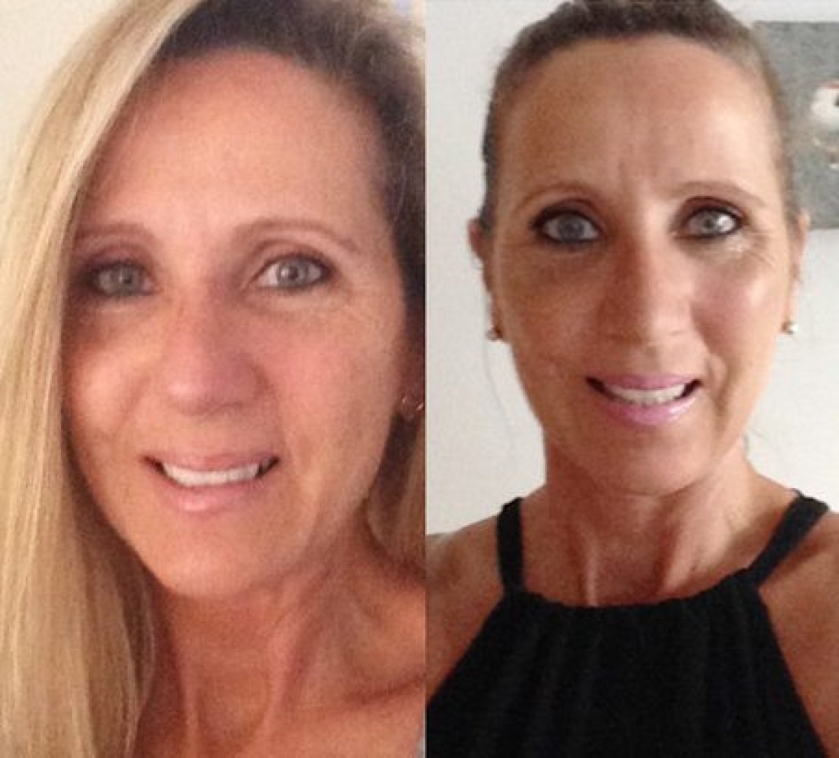 Facelift before and after results at Samitivej Thonburi Hospital – visible facial rejuvenation