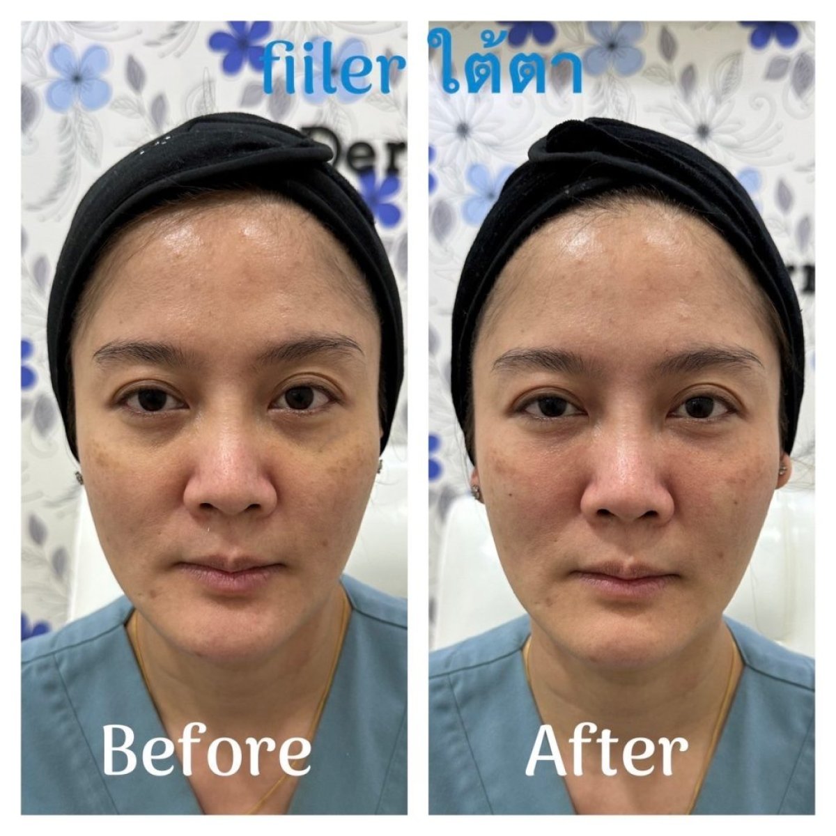Antes y después de rellenos bajo los ojos en ProDerma, reducción visible de ojeras