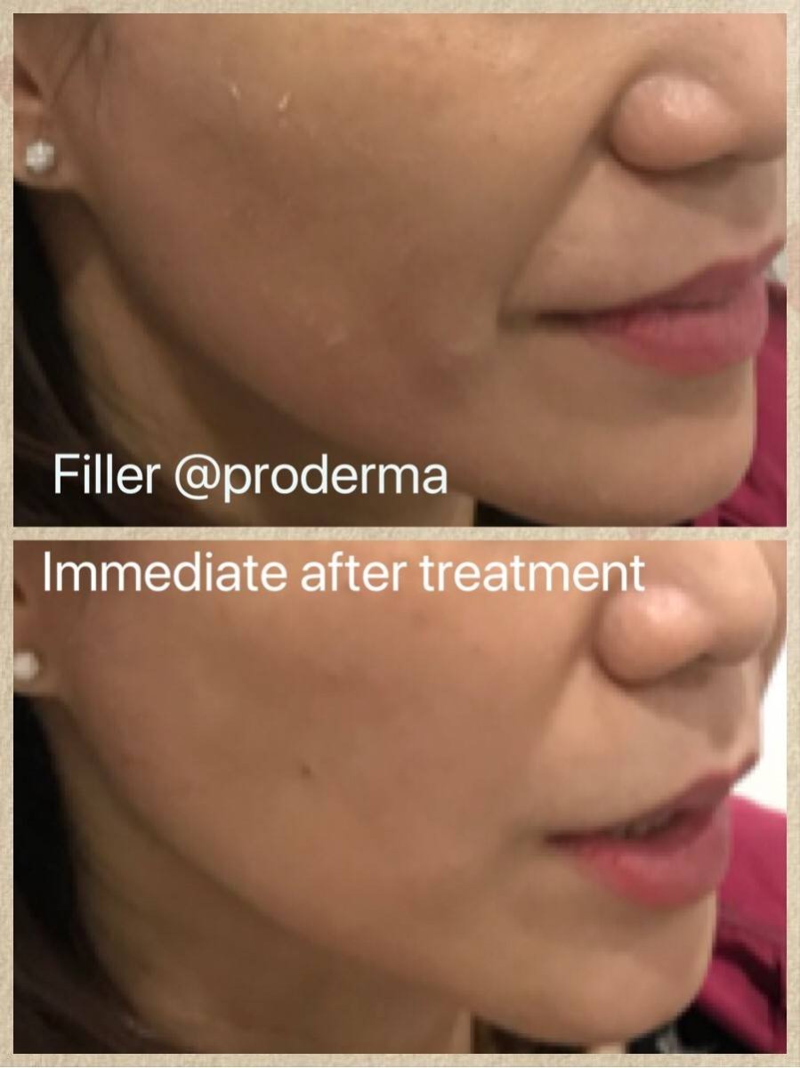 نتائج قبل وبعد حقن الفيلر في ProDerma، تحسين فوري لتحديد ملامح الوجه