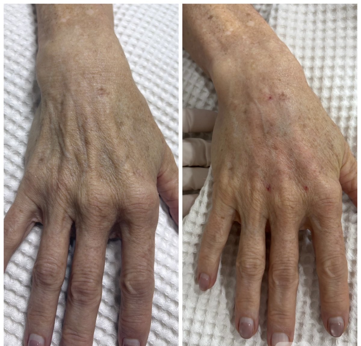 Antes y después de rejuvenecimiento de manos con rellenos en ProDerma, restauración visible