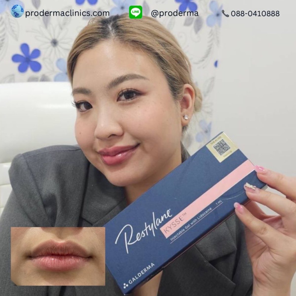 Antes y después de relleno de labios con ácido hialurónico en ProDerma – resultado de volumen