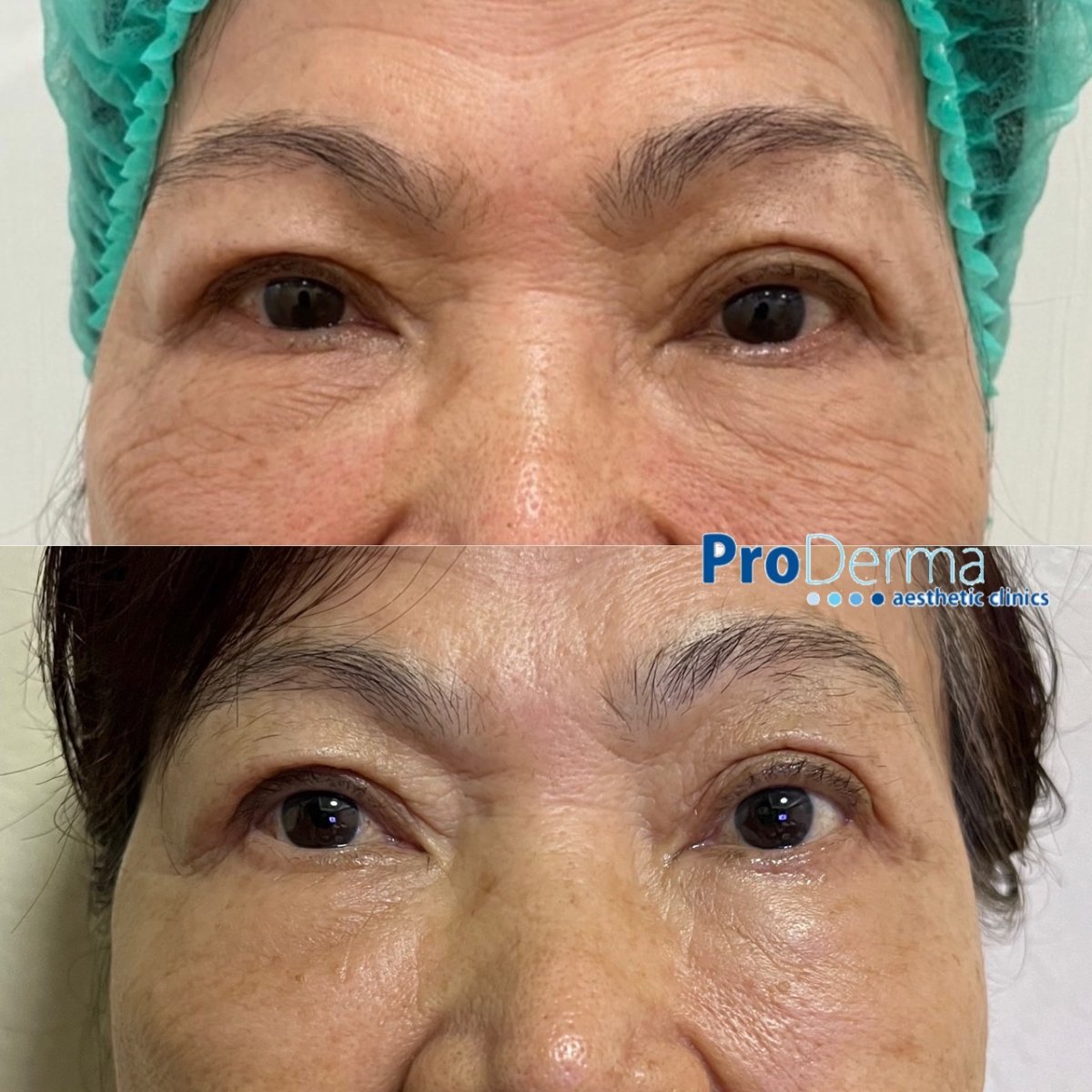 Avant/après Botox rides chez ProDerma, réduction visible des rides autour des yeux
